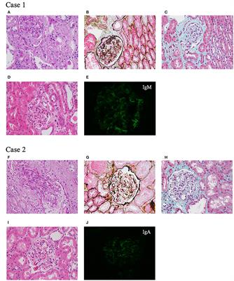 Two Children With Steroid-Resistant Significant Proteinuria Due to Nonsense Mutations of the TRIM8 Gene: A Case Report and Literature Review